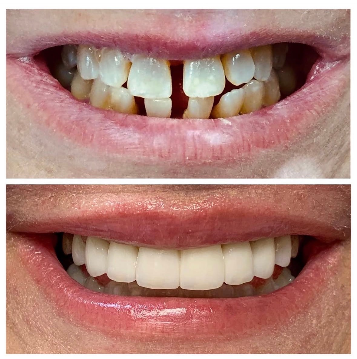 Smile makeover: before (top) and after (bottom)