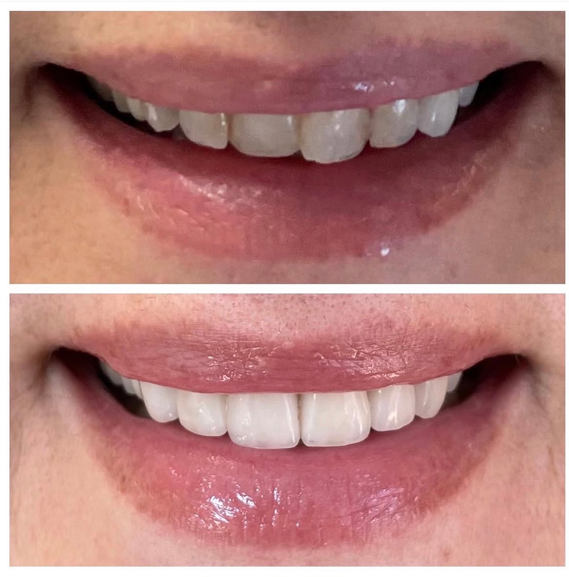 Smile makeover: before (top) and after (bottom)