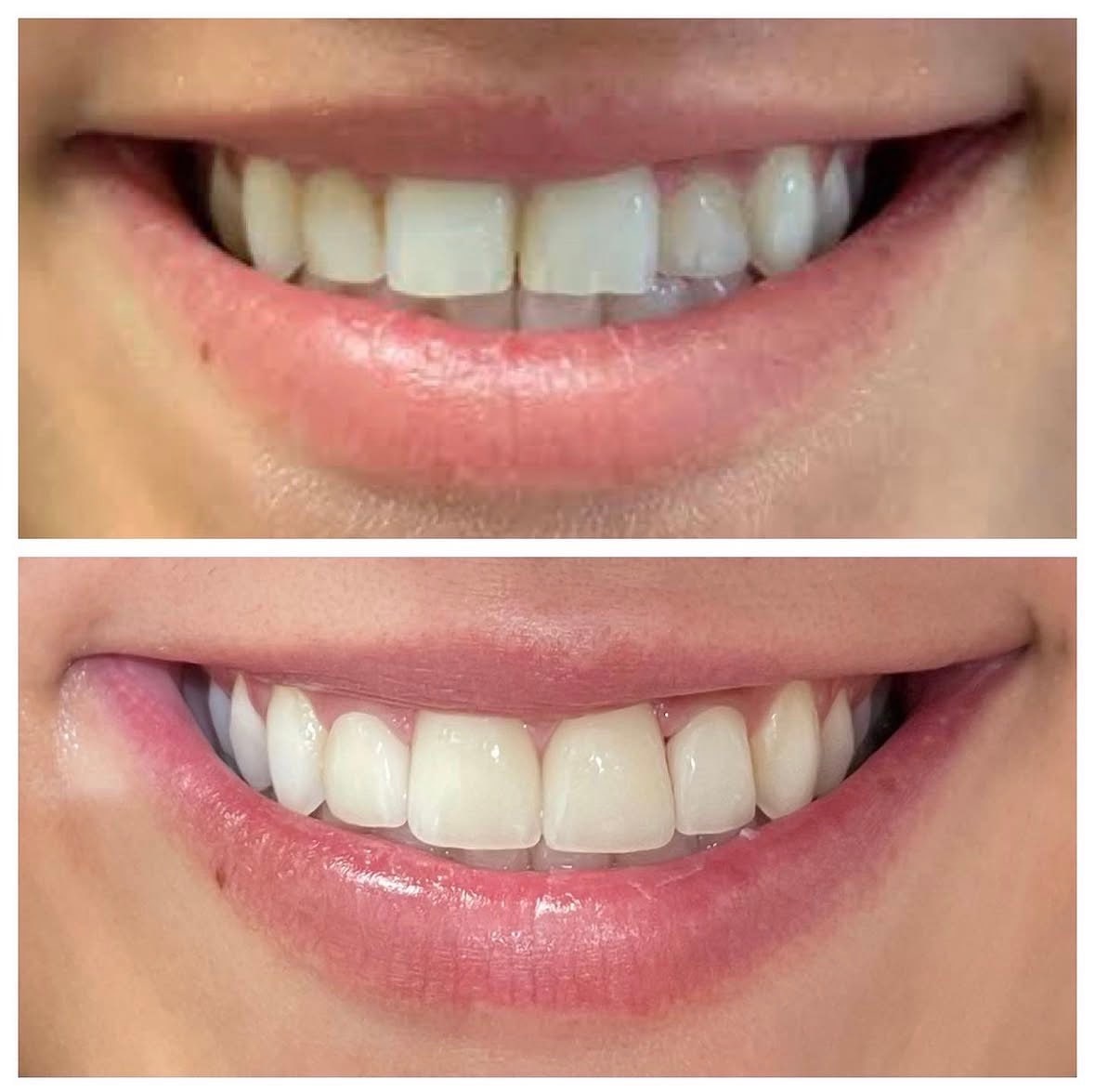Smile makeover: before (top) and after (bottom)